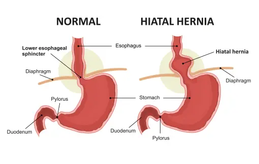 Hiatus Hernia